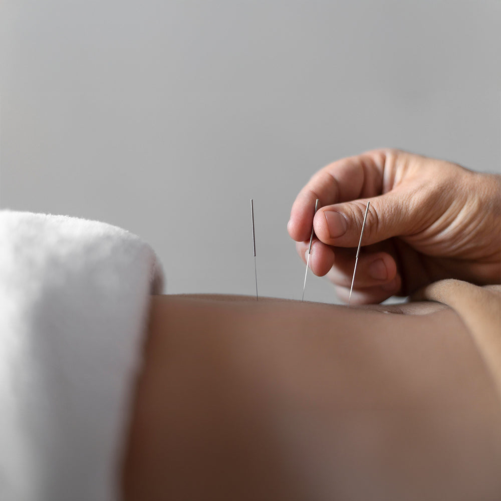 Can Acupuncture Improve Your Sleep?
